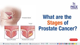 Stages of Prostate Cancer  What are the stages of prostate cancer  prostatecancer [upl. by Kired]