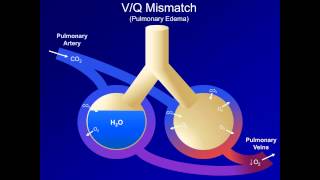 Hypoxia and Hypoxemia Mechanisms and Etiologies ABG Interpretation  Lesson 18 [upl. by Yleen]