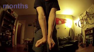 Broken wrist recovery time Ulnar Radius and Scaphoid bones broken surgery [upl. by Naej]