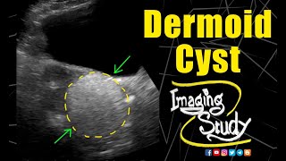 Dermoid Cyst  Ultrasound  Case 164 [upl. by Anivahs588]