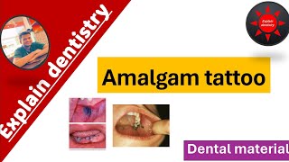 Amalgam tattoo  Dentistry  explaindentistry [upl. by Isleen]