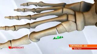 Wright  Ortholoc 3DI Bow Plate [upl. by Adnuahsor]