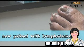 new patient with lymphedema  Dr Nail Nipper [upl. by Ahsoek]