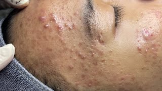 ACNE TREATMENT VU QUYNH MI  Perennial Blackheads On Boy Face 2024FULL [upl. by Renzo]