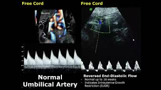 Umbilical Artery Doppler Ultrasound Normal Vs Abnormal Image Appearances  Spectral Doppler USG [upl. by Razid396]