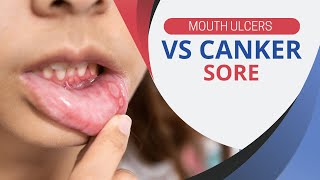 Mouth Ulcer vs Canker Sore Whats the Difference [upl. by Bullion]