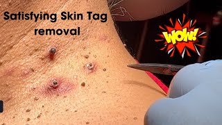 Amazing Satisfying Skin Tag Removal [upl. by Cila]