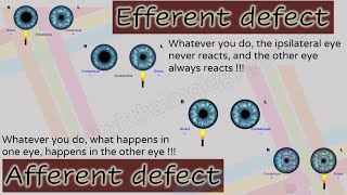 Pupil 2  Characteristics of Afferent and Efferent Pupillary Defects [upl. by Saxet468]