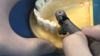 Surgical Smart Ultra Wide Implant Demo [upl. by Hahcim739]