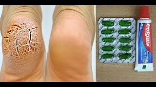 1 ही रात में फटी एड़ियों को कोमल बना देगा  Cracked Heels Home Remedy  Cracked Heels Treatment [upl. by Naicad593]