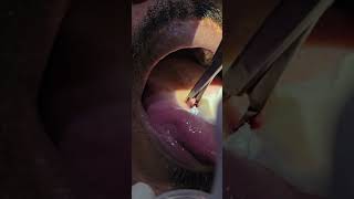 Leukoplakia toungue Laser  Cautery  Dr Hitesh Patel [upl. by Hairabez]