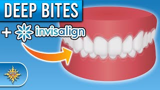 Can Invisalign Fix Deep Bites [upl. by Orest]