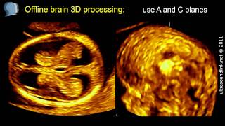 3D scan of the fetal brain at 1113 weeks gestation [upl. by Setarcos]