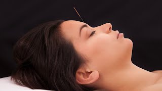 Acupuncture Migraine Relief [upl. by Gasperoni]