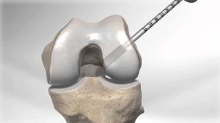 All Inside® ACL Reconstruction with GraftLink™ [upl. by Ilek]