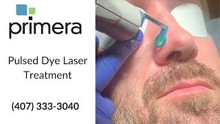 Pulsed Dye Laser Treatment [upl. by Lorrayne582]