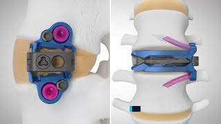 ELSA™ Expandable Integrated Lateral Lumbar Interbody Technique Animation [upl. by Grubb]