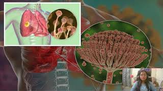 Aspergillosis The Infectious Fungal Disease [upl. by Oswell]