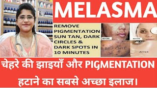 Melasma treatment।Melasma homeopathic treatment।hyperpigmentation को कैसे हटाये। [upl. by Airrotal]