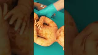 Step by Step Csection procedure 3D  Belly layers in a cesarean cesareanbirth baby csectionmom [upl. by Clovah56]