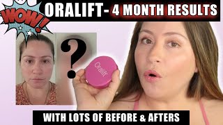 ORALIFT  MY 4 MONTH RESULTS  LOTS OF BEFORE amp AFTERS [upl. by Ahsetan]