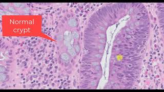 The Diagnosis of a Tubular Adenoma [upl. by Radke]