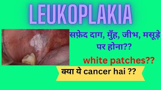 leukoplakiawhite patch causes and treatment [upl. by Ecidnarb]