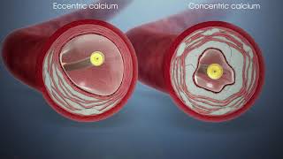 Shockwave Lithotripsy  Fortis Healthcare [upl. by Nylknarf]