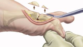 Arthritis of the Big Toe Diagnosis and Treatment at Holy Cross Orthopedic Institute [upl. by Cassell78]