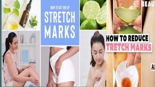 stretch marks ka ilaj  treatment of stretch marks  drmuzammel Ehsan [upl. by Ynnaffit734]