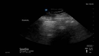 Lung Ultrasound Image Interpretation [upl. by Mellar]