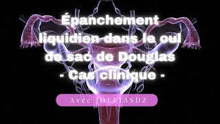 Épanchement liquidien dans le cul de sac de Douglas  Cas clinique [upl. by Presley617]