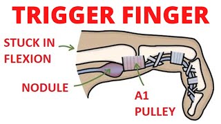 Trigger finger [upl. by Yelrahc]