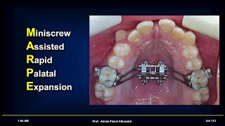 MARPE Miniscrew Assisted Rapid Palatal Expansion Live webinar [upl. by Laerol]