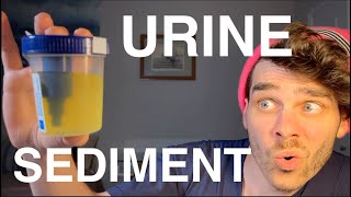 Urine Sediment Analysis  Learn How to Spin Urine  Interpret Cells amp Casts [upl. by Jessalin]