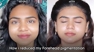 How I Reduced My Forehead Pigmentation with Ponds AntiPigmentation Serum  Before amp After sristy [upl. by Godric]