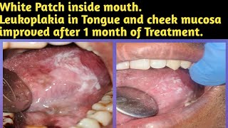 White Patch inside mouthLeukoplakia in Tongue and cheek mucosa improved after 1 month of Treatment [upl. by Zaccaria]