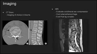 Thoracolumbar Burst Fractures [upl. by Anne]