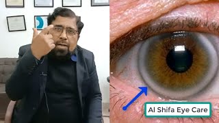 What is Corneal Arcus  Arcus Senilis and Arcus Juvenilis in Urdu Hindi [upl. by Ordnajela]