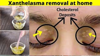 Xanthelasma removal at home  Home remedy to get rid of cholesterol deposits around your eyes natura [upl. by Eladnar]