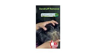 Dandruff Removal  Scratching a Patch of Dandruff Flaky Scalp  itchy scalp ASMAR Scalp care [upl. by Llenrrad]