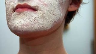 Face Eczema  Atopic Dermatitis  Eczema Dermatitis Rash Treatment [upl. by Jones267]