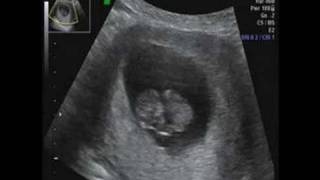 9 weeks 3 days  ultrasound [upl. by Gabi]