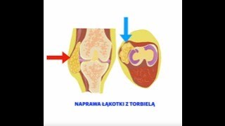 Naprawa łąkotki z cystą Repair of the meniscus lesion with accompanying cyst [upl. by Turoff858]