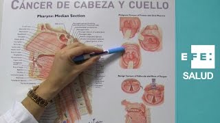 Cáncer en la boca por infecciones tabaco y alcohol [upl. by Elvin20]