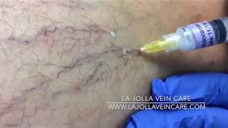 Spider Vein Treatment How sclerotherapy works  Vein Treatment Clinic [upl. by Ainomar988]