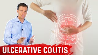 What is Ulcerative Colitis – Causes Symptoms amp Treatment by DrBerg [upl. by Maxim842]