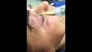 Jett Plasma Lift Medical  Blepharoplasty noninvasive [upl. by Ehman]