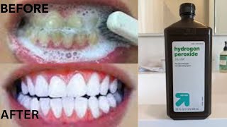 How To Get White Teeth In Just 2 Minutes With Hydrogen PeroxideWhite Teeth HACK [upl. by Bonnee]