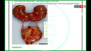 UGS Pathology  Anomalies amp Cystic Kidney Diseases  Mutah [upl. by Licna169]